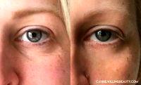 Treating Under Eye Wrinkles With Botox