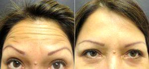 Treatment For Forehead Lines And Crows Feet Before And After By Dr Kim Nichols, MD, Greenwich Dermatologist