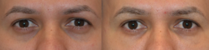 Treatment Of Dark Circles Under The Eyes With Juvederm With Dr Michael A. Zadeh, MD, FACS, Sherman Oaks General Surgeon