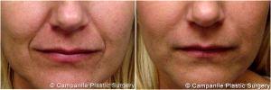 Two Syringes Of Juvederm Into The Nasolabial Folds By Dr. Frank Campanile, MD, Denver CO Plastic Surgeon