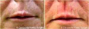 Two Syringes Of Juvederm XC Injected Into Her Lipstick Lines By Dr. Frank Campanile, MD, Denver CO Plastic Surgeon