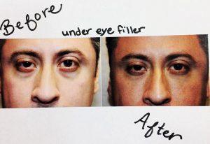 Under Eye Filler By Dr. Lee B. Daniel, Plastic Surgeon In Eugene, Oregon