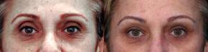 Upper Eyelid Filler With Restylane With Dr Gal Aharonov, MD, Beverly Hills Facial Plastic Surgeon