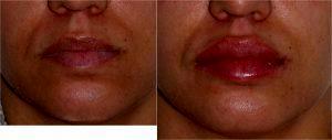 Volbella Filler to Tear Troughs. Juvederm Ultra XC to Lips by Dr. Otto J. Placik, Chicago Plastic Surgeon (1)