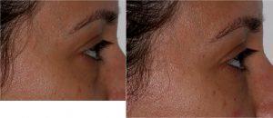 Volbella Filler to Tear Troughs. Juvederm Ultra XC to Lips by Dr. Otto J. Placik, Chicago Plastic Surgeon (2)