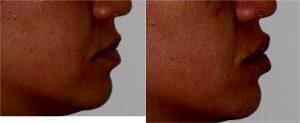 Volbella Filler to Tear Troughs. Juvederm Ultra XC to Lips by Dr. Otto J. Placik, Chicago Plastic Surgeon (3)