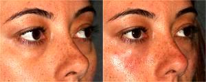 Volbella Injections to Tear Troughs by Dr. Otto J. Placik, Chicago Plastic Surgeon (2)