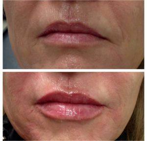 Volbella On The Lips And Juvederm In The Nasolabial Fold At Skinique Med Spa & Wellness In Dallas