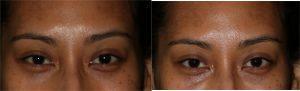 Volbella filler to Tear Troughs by Dr. Otto J. Placik, Chicago Plastic Surgeon (1)