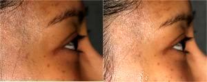Volbella filler to Tear Troughs by Dr. Otto J. Placik, Chicago Plastic Surgeon (2)