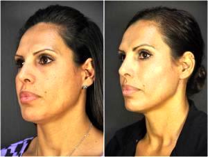 Voluma In The Tear Troughs And Cheeks By Dr. Goesel Anson, Plastic Surgeons In The Clark County, Nevada (2)