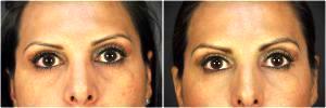 Voluma In The Tear Troughs And Cheeks By Dr. Goesel Anson, Plastic Surgeons In The Clark County, Nevada (3)