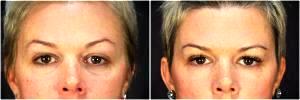 Voluma In The Tear Troughs, Cheeks And Jowl Line By Dr. Goesel Anson, Plastic Surgeons In The Clark County, Nevada (3)