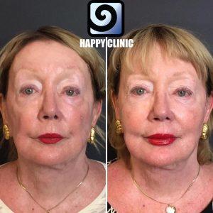 Voluma To Cheeks And Vollure To Lips, As Well As A Little Botox To Soften Lines At Happy Clinic Denver