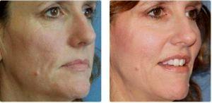 Voluma XC And Botox By Dr. Dina Eliopoulos, MD, Chelmsford MA Plastic Surgeon