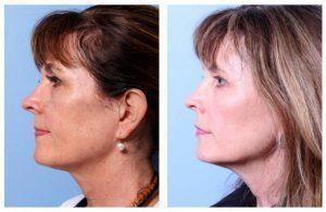 Voluma XC to the cheek area by Dr. George Moynihan, Chicago, IL Facial Plastic Surgeon (1)