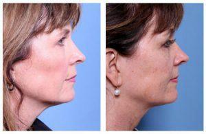 Voluma XC to the cheek area by Dr. George Moynihan, Chicago, IL Facial Plastic Surgeon (3)