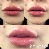 What's Better For Lip Enhancement