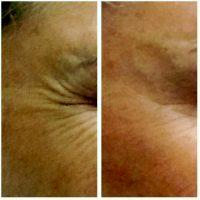 When Can I See Results Of A Botox For Crow's Feet Treatment