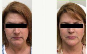 Woman Treated With Botox And Restylane