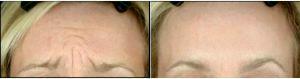Woman Treated With Botox Before And After With Dr Amy Forman Taub, MD, Chicago Dermatologic Surgeon