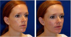 Woman Treated With Sculptra Aesthetic By Dr. Matthew Richardson, MD, Frisco TX Facial Plastic Surgeon
