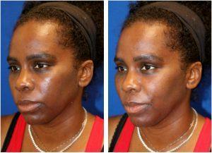 Woman Treated With Voluma To The Cheeks By Dr. Matthew Richardson, MD, Frisco TX Facial Plastic Surgeon