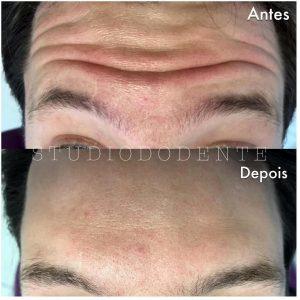 Wrinkles In Forehead Botox Before And After Images