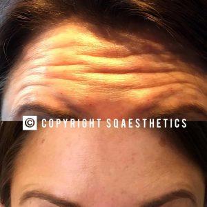 Wrinkles In Forehead Botox Before And After Pics (1)