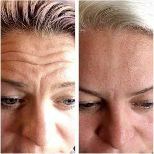 Wrinkles In Forehead Botox Before And After Pics (3)