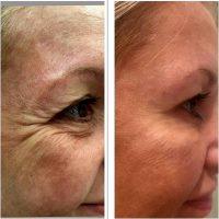 Xeomin For Crows Feet Befpre And After