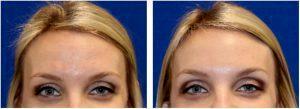 Xeomin To Forehead, Glabella, And Crow's Feet By Dr. Matthew Richardson, MD, Frisco TX Facial Plastic Surgeon (1)