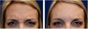 Xeomin To Forehead, Glabella, And Crow's Feet By Dr. Matthew Richardson, MD, Frisco TX Facial Plastic Surgeon (2)