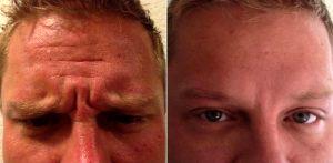 Young Male Treated For Forehead And Glabellar Wrinkles Results By Dr Jason Emer, MD, Los Angeles Dermatologic Surgeon