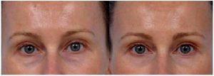 an under eye filler treatment by Dr. Steven H. Dayan, MD, Doctor in Chicago, Illinois