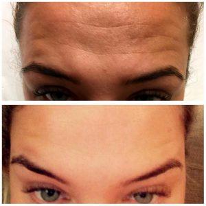 botox before after pictures forehead wrinkles (2)