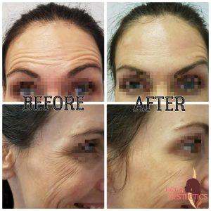 botox before after pictures forehead wrinkles (3)
