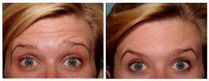 botox for forehead lines by Gold Coast Plastic Surgery, Chicago, IL