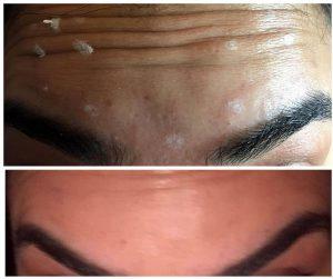 botox for forehead wrinkles photos (1)