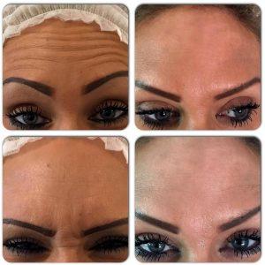 botox for forehead wrinkles photos (2)