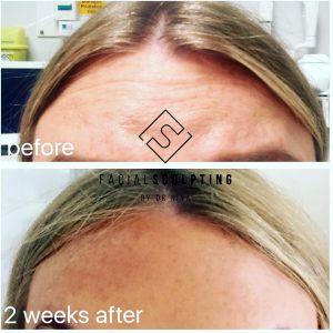 botox forehead horizontal lines before and 2 weeks after