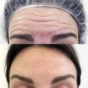 botox in forehead wrinkles photos (1)
