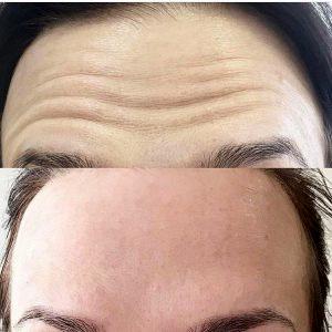 botox in forehead wrinkles photos (2)