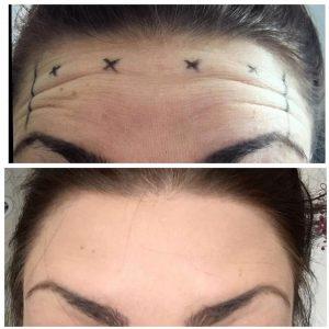 botox injection forehead wrinkles before after (1)
