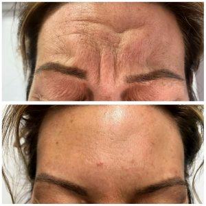botox injection forehead wrinkles before after (2)