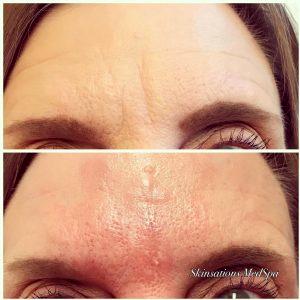 botox to prevent forehead wrinkles picture