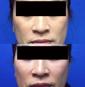 1 Syringe Of Vollure On Each Side Of Her Tear Troughs At Laser Clinique In San Diego, California