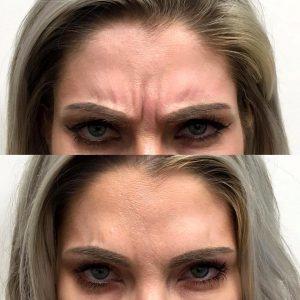 16 Units Of Xeomin By Lisa Acevedo RN At Laser Clinique In San Diego, California