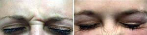 20 Year Old Woman Treated With Botox Before & After By Dr Byron A. Long, MD, Marietta Oculoplastic Surgeon