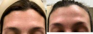 21 Year Old Man Treated With Botox Before & After With Dr. Satyen Undavia, MD, Philadelphia Facial Plastic Surgeon
